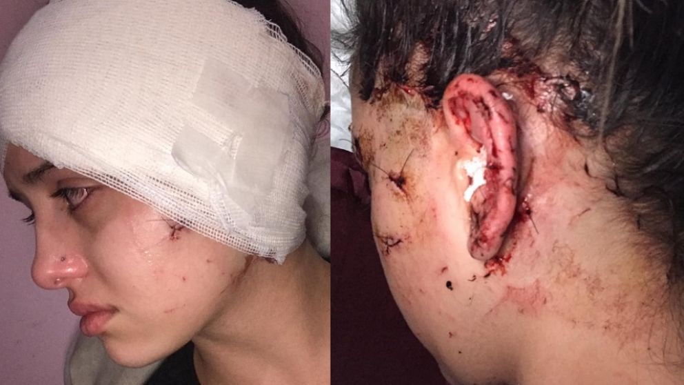 Acoso, violencia y más de 20 puntos de sutura: habló la moza agredida brutalmente en la Arístides